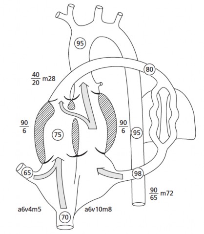 Hình 1 6 Sinh lý bệnh ToF ở trẻ sơ sinh có hẹp mức độ trung bình đường 2