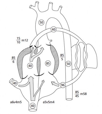 Hình 1 7 Sinh lý bệnh ToF ở trẻ nhũ nhi có hẹp nặng đường thoát thất phải 3