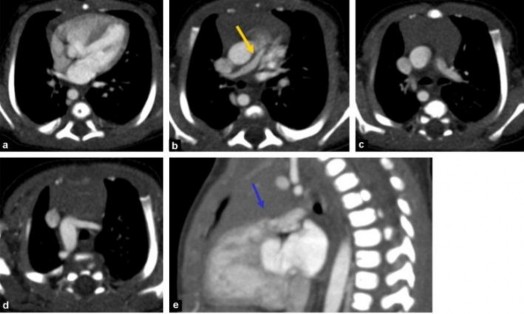 Hình 1 9 Chụp điện toán cắt lớp tim của bệnh nhân ToF nặng Hình a lỗ TLT và 1