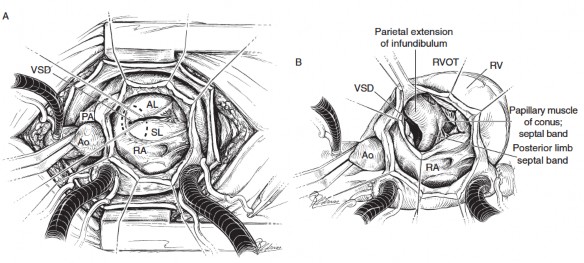 Hình 2 1 Giải phẫu đường thoát thất phải trong ToF tiếp cận qua van ba lá 1