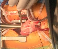 Hình 2 8 Đánh giá vòng van ĐMP bằng Hegar sau khi thao tác trên lá van Nếu vòng van 10