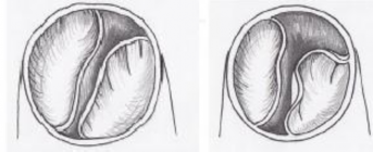 Hình 2 9 Kĩ thuật tách rộng mép van để làm tăng diện tích lỗ van ĐMP Nguồn 11