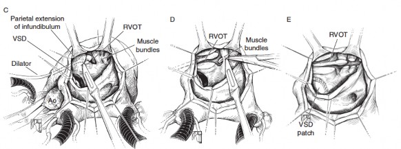 Hình 2 2 Kĩ thuật cắt hẹp đường thoát thất phải tiếp cận qua van ba lá 2