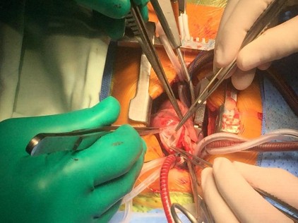 Hình 2 3 Tiếp cận van ĐMP và vòng van qua đường mở thân ĐMP Việc đánh giá 3