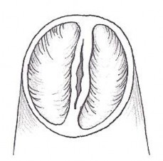 Hình 2 4 Kĩ thuật xẻ mép van động mạch phổi bị dính làm rộng lỗ van 4
