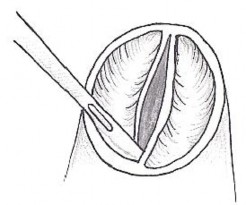 Hình 2 4 Kĩ thuật xẻ mép van động mạch phổi bị dính làm rộng lỗ van 5