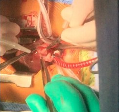 Hình 2 6 Kĩ thuật tạo hình lá van động mạch phổi Một số trường hợp mô 6