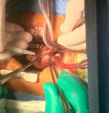 Hình 2 6 Kĩ thuật tạo hình lá van động mạch phổi Một số trường hợp mô 7