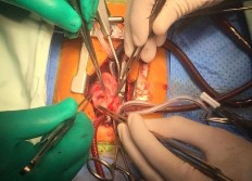 Hình 2 8 Đánh giá vòng van ĐMP bằng Hegar sau khi thao tác trên lá van Nếu vòng van 9