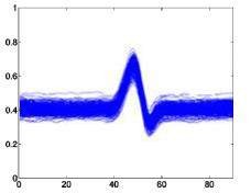 Ngoại tâm thu nhĩ – A Tâm thất nỗi nhịp – E Block nhánh trái –L Block nhánh 1
