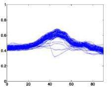 Ngoại tâm thu nhĩ – A Tâm thất nỗi nhịp – E Block nhánh trái –L Block nhánh 2