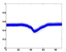 Block nhánh trái –L Block nhánh phải – R Rung thất – I Ngoại tâm thu thất V 3