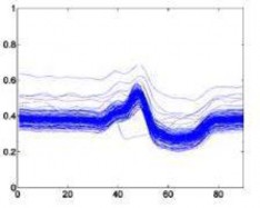 Block nhánh trái –L Block nhánh phải – R Rung thất – I Ngoại tâm thu thất V 4