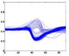 Rung thất – I Ngoại tâm thu thất V Hình 4 1 Hình dáng mẫu phức bộ QRS của 6