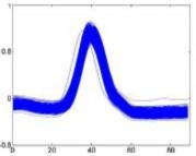 Ngoại tâm thất thu – V Loạn nhịp thất trên – S Bình thường – N Hình 4 2 7