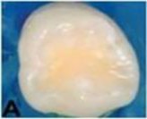 ICDAS 4 Có bóng đen bên dưới từ ngà răng ánh qua bề mặt men liên tục ICDAS 1 1