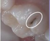 ICDAS 1 Thay đổi nhìn thấy sau khi thổi khô đốm trắng đục hay màu nâu ICDAS 5 2