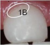 ICDAS 5 Có lỗ sâu lộ ngà răng ICDAS 2 Thay đổi được nhìn rò trên men răng ướt 3