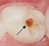 ICDAS 2 Thay đổi được nhìn rò trên men răng ướt và lan rộng qua hố rãnh ICDAS 6 4