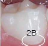 ICDAS 6 Có lỗ sâu lớn lộ ngà răng >1/2 mặt răng ICDAS 3 Mất chất khu trú ở men 5