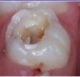 ICDAS 3 Mất chất khu trú ở men không lộ ngà 6