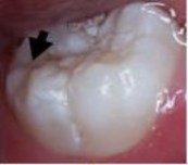 Lớn lộ ngà răng >1/2 mặt răng ICDAS 3 Mất chất khu trú ở men (không lộ ngà) 7