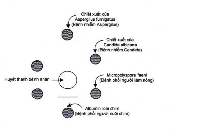 Hình 12 10 Phát hiện kháng thể kết tủa trong viêm phế nang dị ứng ngoại sinh 3