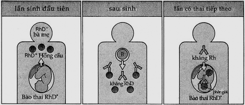 Hình 9 7 Bệnh huyết tán trẻ sơ sinh Hồng cầu phôi có Rh vào tuần hoàn mẹ 4