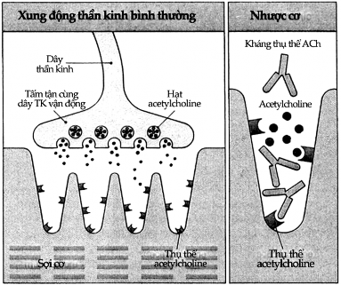 Hình 9 9 Bệnh nhược cơ nặng Bình thường xung động thần kinh được truyền 6