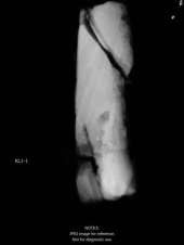 Ảnh 46 Ảnh X quang hiện vật kim loại tại HĐĐ tại 19 CQ H2 Nguồn Bệnh viện 17