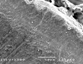 Hình 3 1 Hình ảnh tổn thương hủy khoáng ở độ phóng đại 200 – 500 lần 2