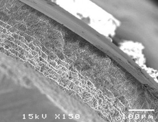 Hình 3 10 Hình ảnh sâu răng D 2 sau điều trị bằng Clinpro TM XT varnish ở độ 20