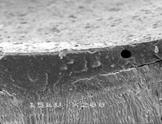 Hình 3 10 Hình ảnh sâu răng D 2 sau điều trị bằng Clinpro TM XT varnish ở độ 21