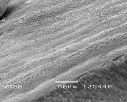 Hình 3 12 Hình ảnh tái khoáng của tổn thương sâu răng D 2 sau điều trị bằng 23