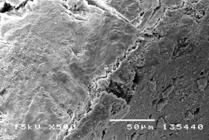 Hình 3 13 Hình ảnh của tổn thương sâu răng D 2 sau điều trị bằng Clinpro TM XT 24