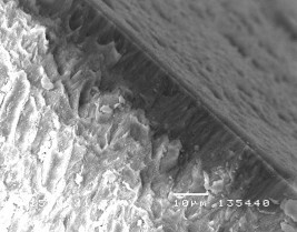 Hình 3 14 Hình ảnh tái khoáng của tổn thương sâu răng D 2 sau điều trị bằng 25