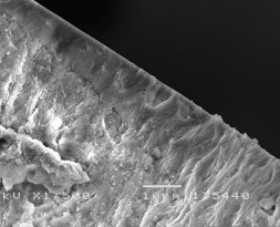 Hình 3 14 Hình ảnh tái khoáng của tổn thương sâu răng D 2 sau điều trị bằng 26