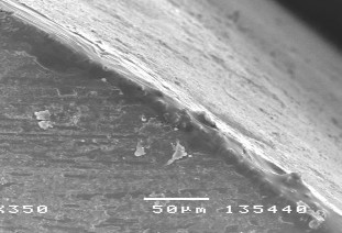 Hình 3 17 Hình ảnh sâu răng D 1 sau điều trị bằng Clinpro TM XT varnish ở độ 29