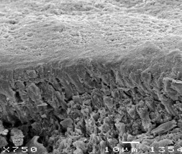 Hình 3 2 Hình ảnh tổn thương hủy khoáng ở độ phóng đại 750 – 1000 lần 3