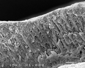 Hình 3 2 Hình ảnh tổn thương hủy khoáng ở độ phóng đại 750 – 1000 lần 4