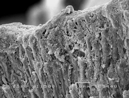 Hình 3 3 Hình ảnh tổn thương hủy khoáng ở độ phóng đại 1500 – 2000 lần 5