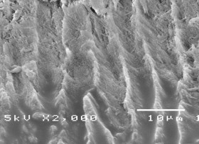 Hình 3 3 Hình ảnh tổn thương hủy khoáng ở độ phóng đại 1500 – 2000 lần 6