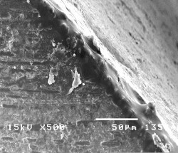 Hình 3 18 Hình ảnh sâu răng D 1 sau điều trị bằng Clinpro TM XT varnish ở độ 1