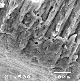 Hình 3 25 Hình ảnh tái khoáng tổn thương D 2 sau điều trị bằng Enamel Pro varnish 10