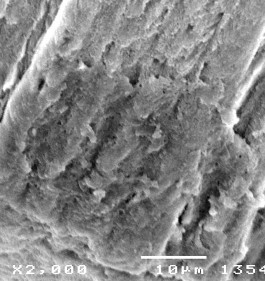 Hình 3 25 Hình ảnh tái khoáng tổn thương D 2 sau điều trị bằng Enamel Pro varnish 11