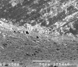 Hình 3 18 Hình ảnh sâu răng D 1 sau điều trị bằng Clinpro TM XT varnish ở độ 2