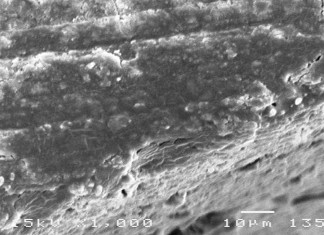 Hình 3 20 Hình ảnh sâu răng D 1 sau điều trị bằng Clinpro TM XT varnish ở độ 4