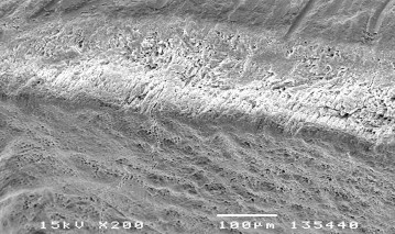 Hình 3 21 Hình ảnh sâu răng D 2 sau điều trị bằng Enamel Pro varnish ở độ phóng 5