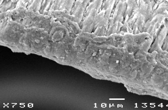 Hình 3 23 Hình ảnh tái khoáng tổn thương D 2 sau điều trị Enamel Pro varnish ở 8