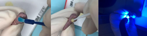 MỘT SỐ HÌNH ẢNH MINH HỌA NGHIÊN CỨU THỰC NGHIỆM Răng đã được chuẩn bị 3